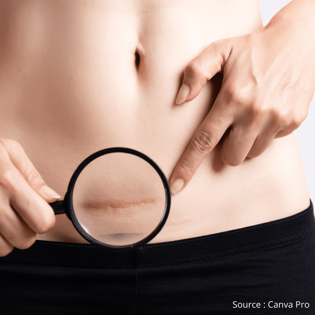 Masser ta cicatrice de césarienne